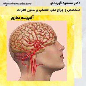 آنوریسم مغزی - دکتر مسعود قهرمانلو - drghahremanlou.com