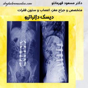 دیسک دژنراتیو - دکتر مسعود قهرمانلو - drghahremanlou.com