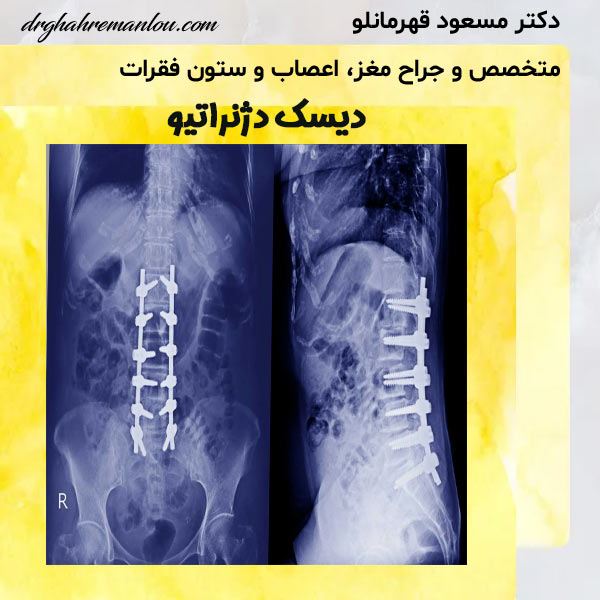 دیسک دژنراتیو - دکتر مسعود قهرمانلو - drghahremanlou.com