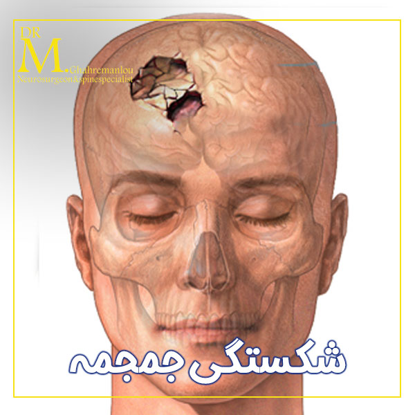 شکستگی جمجمه + دکتر مسعود قهرمانلو