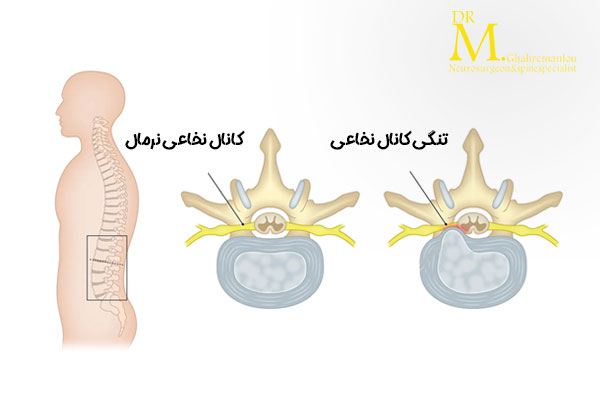 تنگی کانال نخاعی + دکتر مسعود قهرمانلو