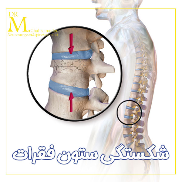 شکستگی ستون فقرات + دکتر مسعود قهرمانلو