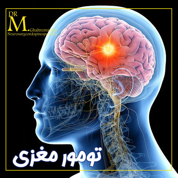 تومور مغزی + دکتر مسعود قهرمانلو