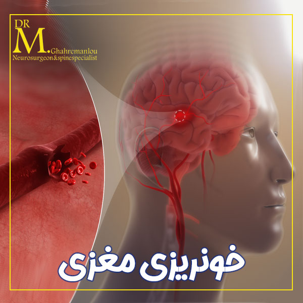 خونریزی مغزی + دکتر مسعود قهرمانلو