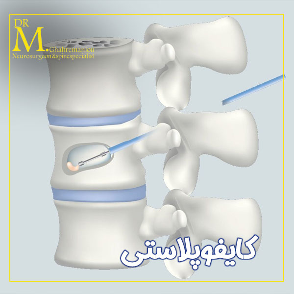 کایفوپلاستی + دکتر مسعود قهرمانلو