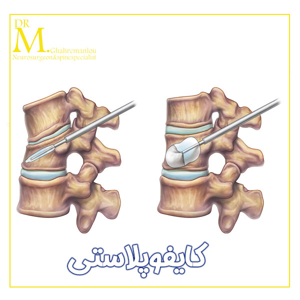 کایفوپلاستی + دکتر مسعود قهرمانلو