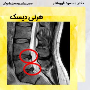 هرنی دیسک - دکتر مسعود قهرمانلو - drghahremanlou.com