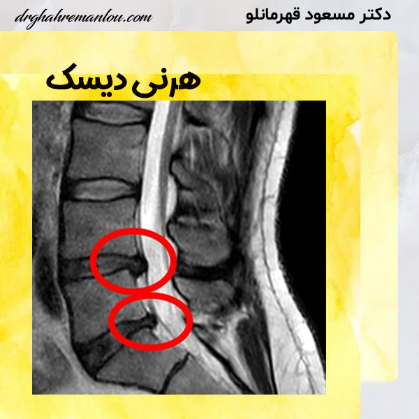 هرنی دیسک - دکتر مسعود قهرمانلو - drghahremanlou.com