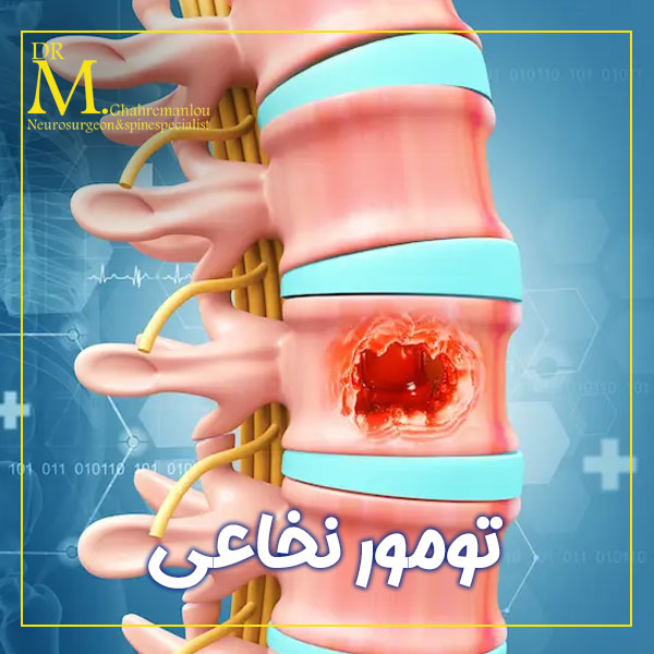 تومور نخاعی + دکتر مسعود قهرمانلو