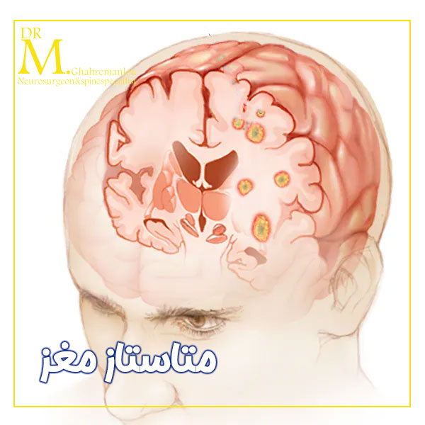 متاستاز مغز + دکتر مسعود قهرمانلو