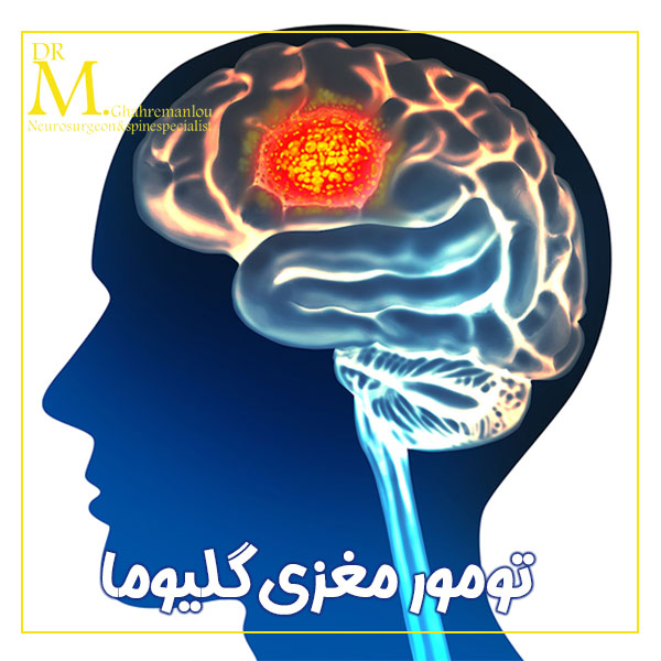 تومور مغزی گلیوما + دکتر مسعود قهرمانلو